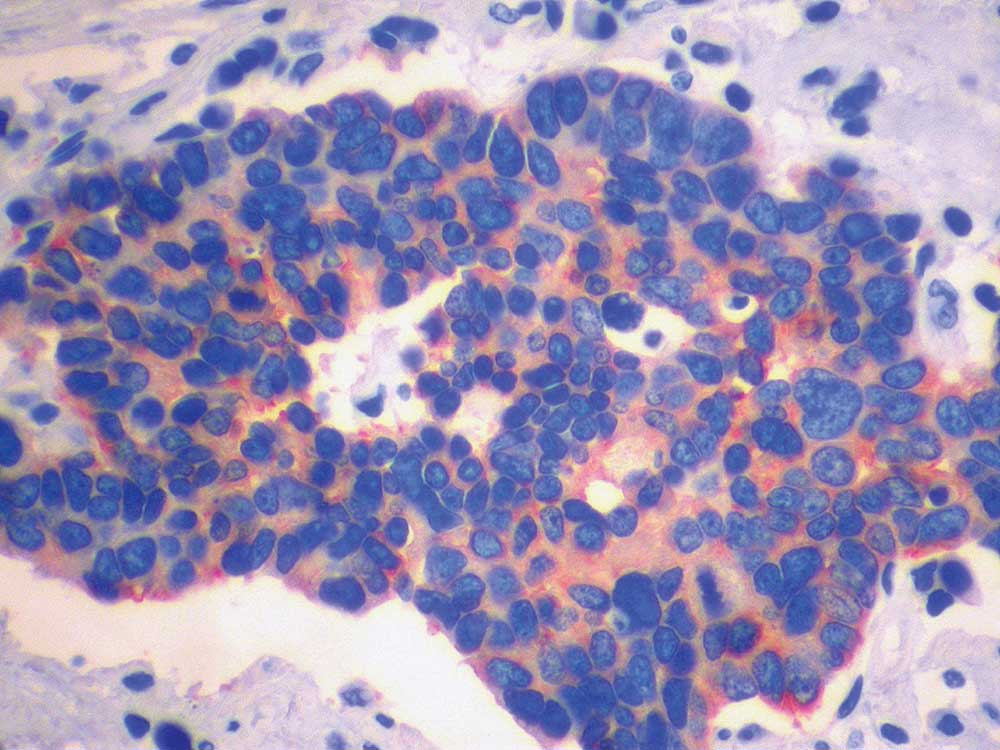 small lung cancer cells